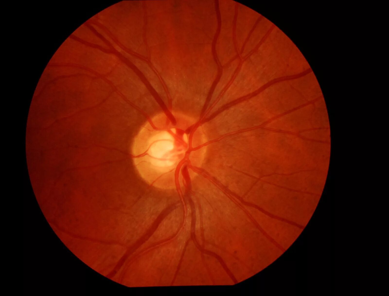 Тип зрительного нерва. Ишемическая нейропатия глазное дно. Зрительный нерв глаукома. ОСТ ДЗН глаукома. Глиобластома зрительного нерва гистология.