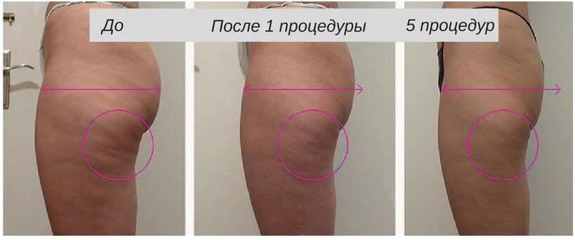 Липолитики против целлюлита до и после. Липолитики уколы от целлюлита. Шарко до и после