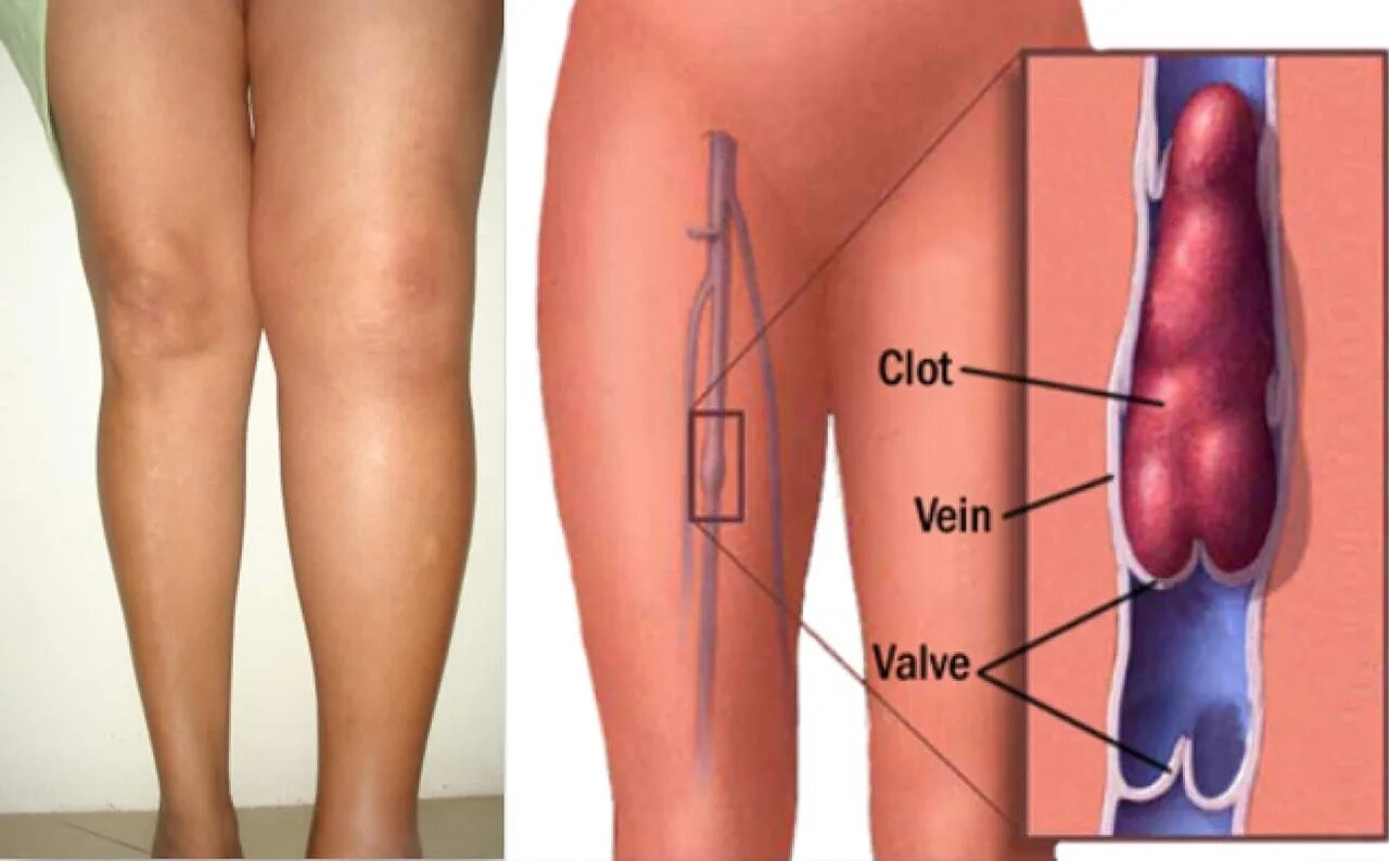 Тромбофлебит Варикотромбофлебит. Илеофеморальный флеботромбоз. Тромбофлебит икроножной мышцы. Как снизить тромбоз
