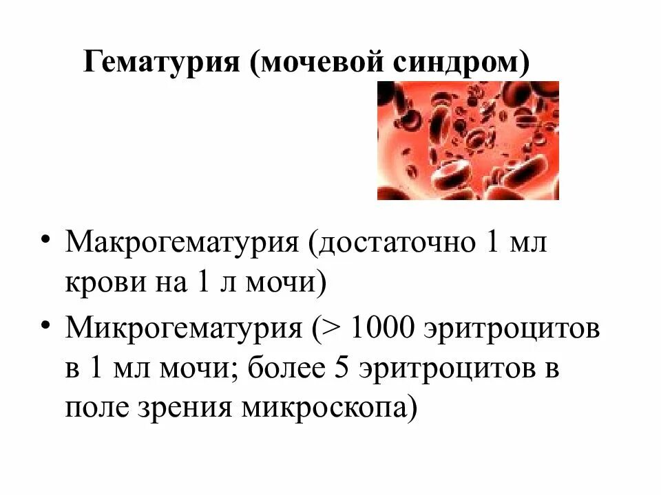 Мочевой синдром гематурия. Синдром микрогематурии. Микрогематурия при гломерулонефрите. Гематурия при гломерулонефрите.