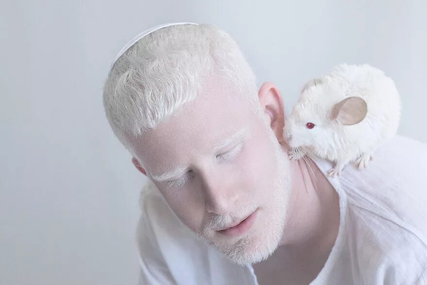 Как люди рождаются альбиносами. Rosie Crawford альбинос. Шимон альбинос.