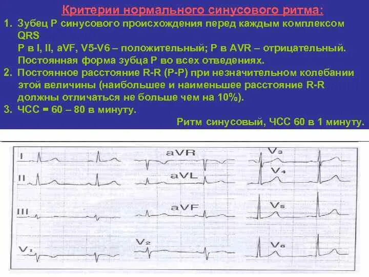 Зубцы р после qrs. Отрицательный зубец p в 1 отведении. отрицательный комплекс qrs. положительный qrs в avr. отрицательный комплекс qrs во 2 отведении.