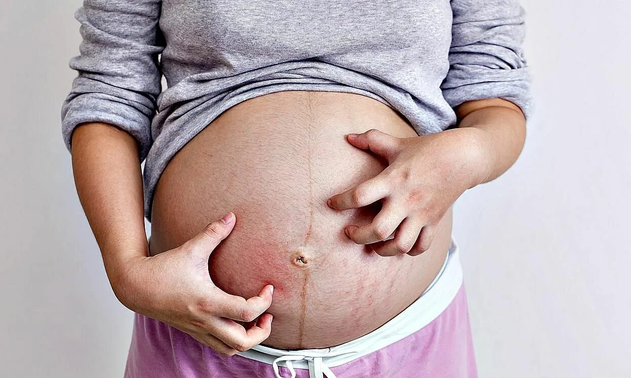 Живот на первом триместре. Живот беременной. Аллергия при беременности.