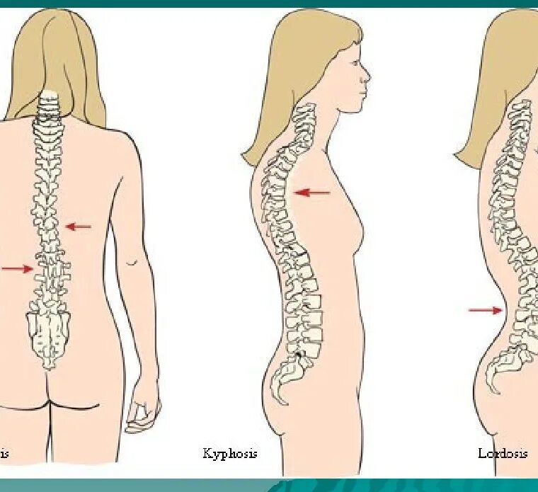 Нарушение изгиба позвоночника. Лордоз грудного отдела позвоночника. Искривление позвоночника лордоз. Лордоз крестцового отдела позвоночника. Кифоз поясничного отдела позвоночника.