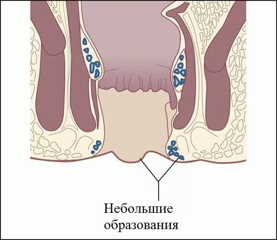 Геморроидальные узлы заднего прохода