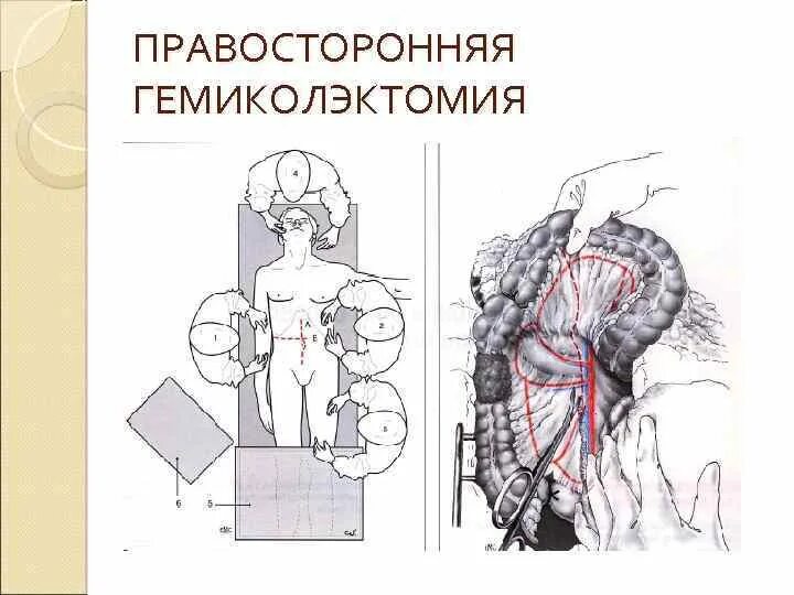 Правосторонняя гемиколэктомия ход операции. Правосторонняя гемиколэктомия по Лахею. Гемиколэктомия с илеотрансверзоанастомозом. Правосторонняя гемиколэктомия схема операции. Колэктомия это