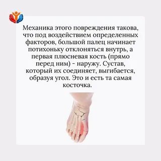 Рост косточки на большом пальце