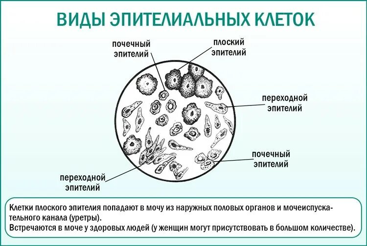 Повышенный эпителий плоский и лейкоциты. Микроскопическое исследование мочи почечный эпителий. плоский эпителий в моче микроскопия. микроскопия мочевого осадка. почечный эпителий. микроскопия мочи почечный эпителий.