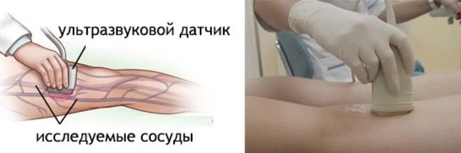 Подготовка узи нижних вен. Уздг сосудов вен нижних конечностей. ультразвуковая допплерография вен нижних конечностей. уздг сосудов (артерий и вен) нижних конечностей. ультразвуковая допплерография сосудов нижних конечностей.