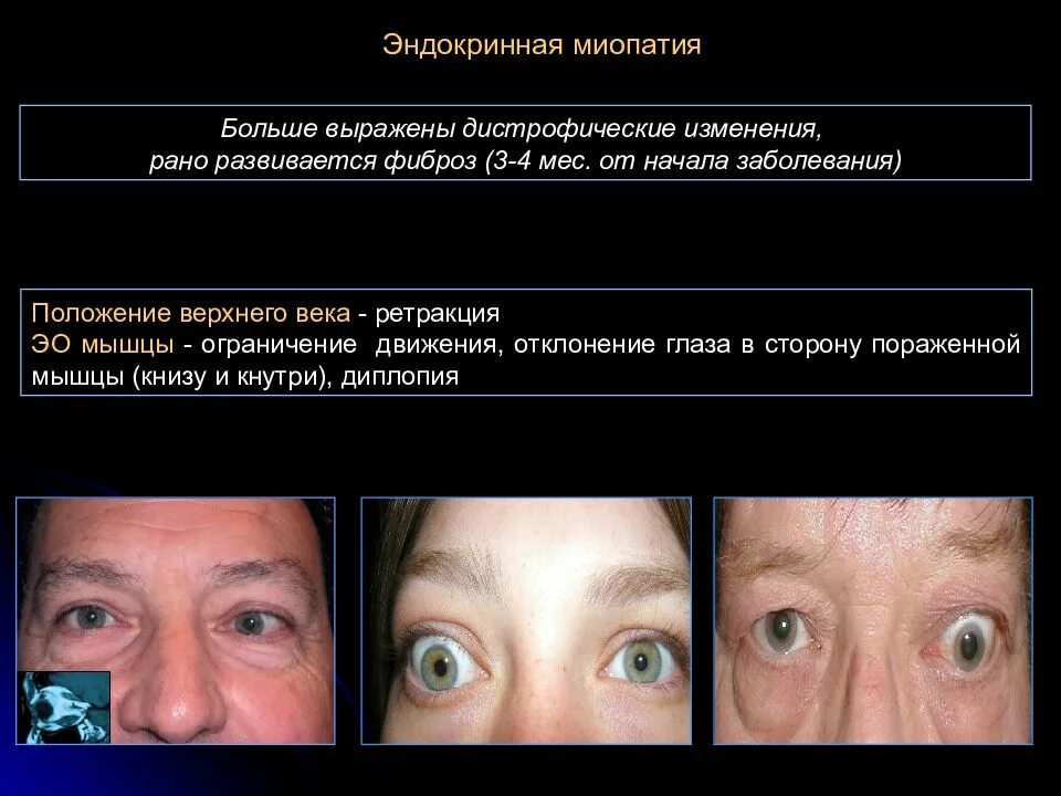 Миопатия глаза что это. Ретракция верхнего века. Эндокринная офтальмопатия степени.