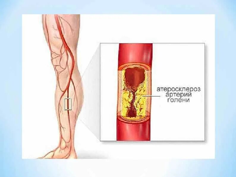 Артерий атеросклероз латынь. Облитерирующий атеросклероз сосудов конечностей. Облитерирующий атеросклероз сосудов ног. Локализации атеросклероза артерий конечностей. Стеноз артерий нижних конечностей.