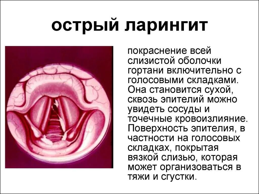 Как лечить голосовые. Заболевания гортани острый ларингит. Острый катаральный ларингит клиника. Воспаление слизистой оболочки гортани - ларингит. Острый катаральный ларингит симптомы.