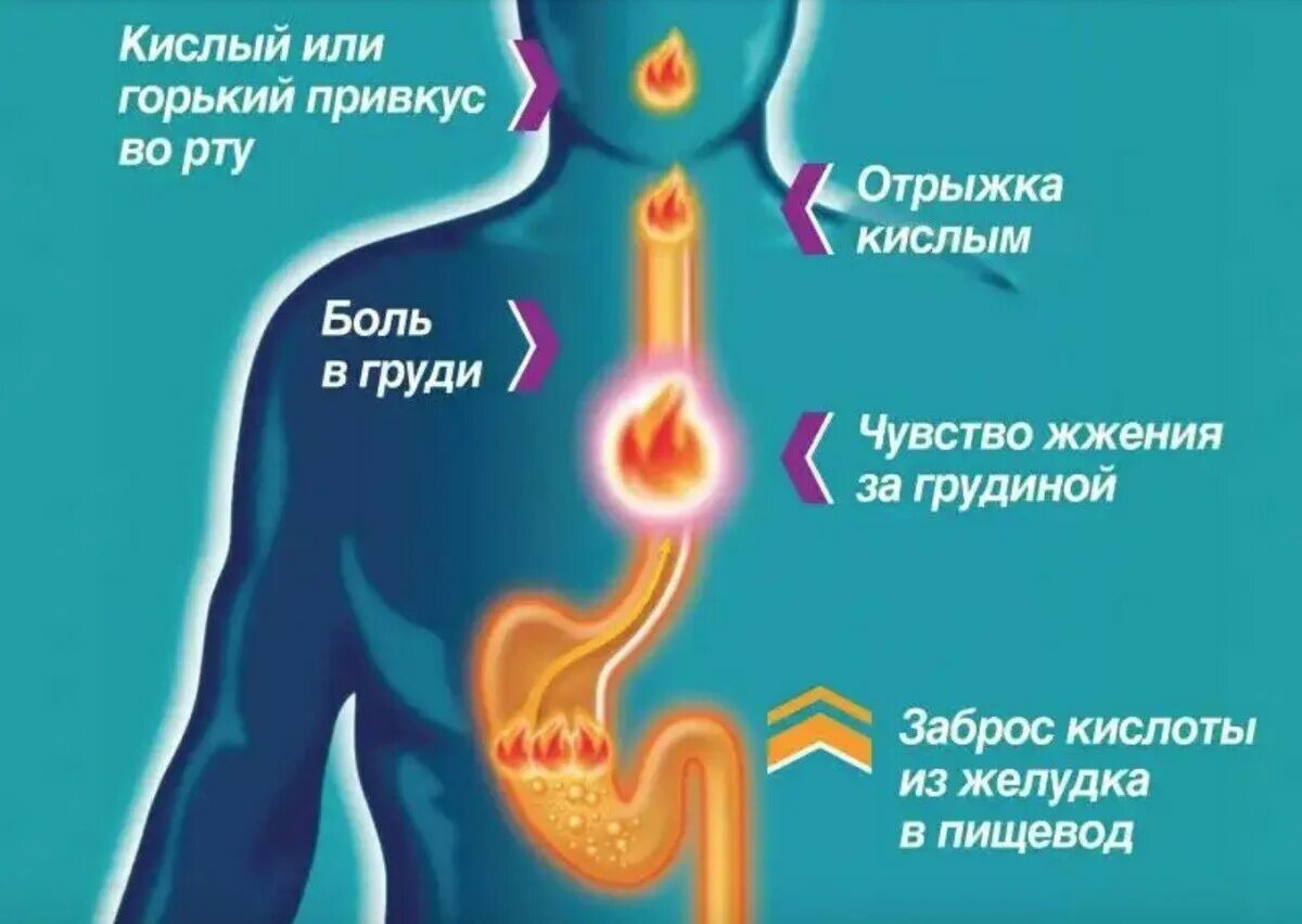 Простуда желудка. Симптомы изжоги желудка. Основные причины изжоги.