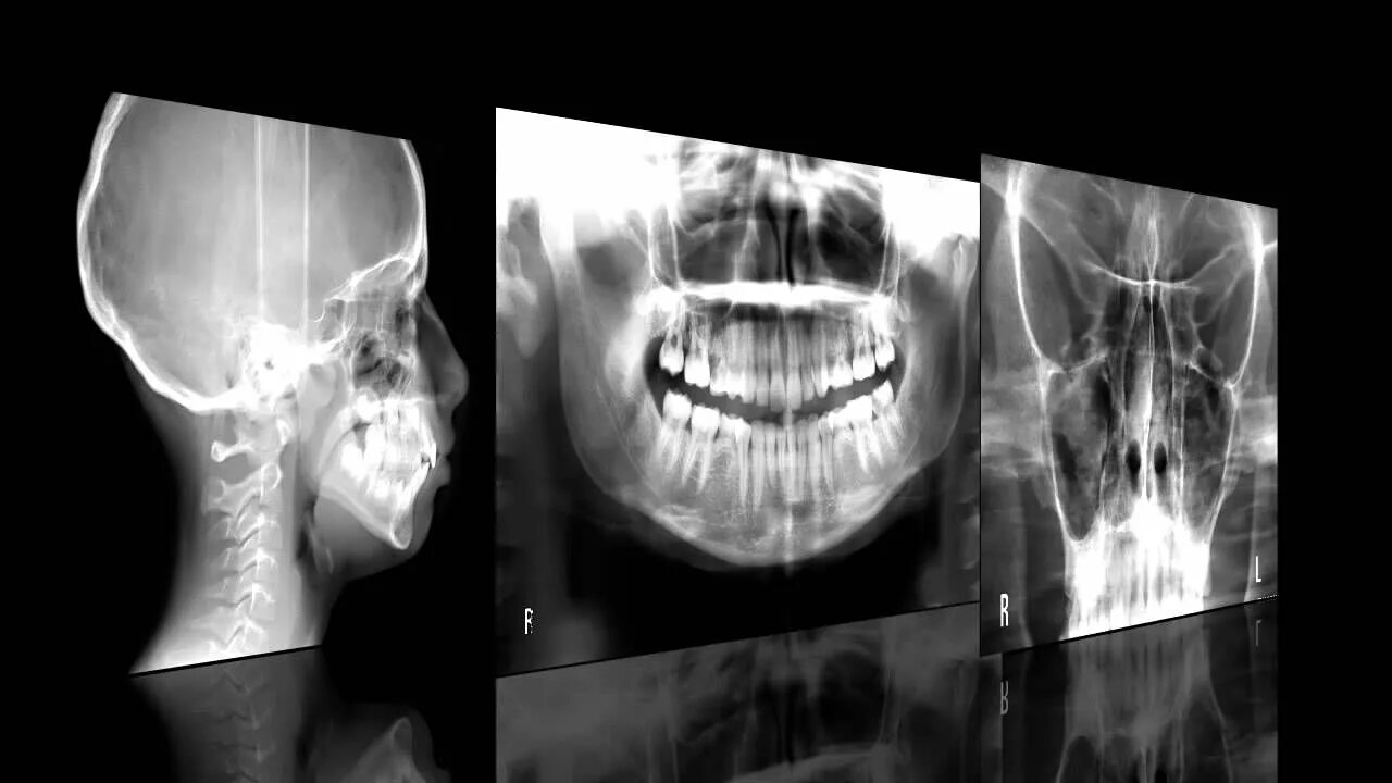 Hyperion x7 цифровой ортопантомограф. MYRAY Hyperion. Панорамная рентгенография верхних конечностей цифровая сшивка.