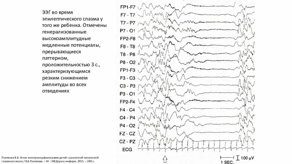 Срок ээг. Эпилепсия на ЭЭГ. Эпилептиформные паттерны на ЭЭГ. ЭЭГ больного эпилепсией. ЭЭГ показатели больного эпилепсией.