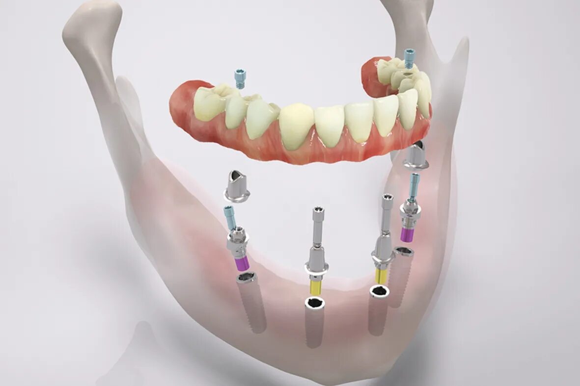 Импланты Straumann Pro Arch. (Метод имплантации all-on-4)методы. Несъемные зубные протезы. Имплантация зубов all on 6
