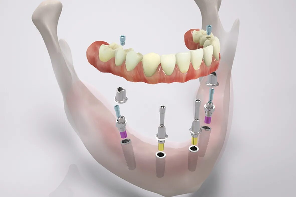 Импланты Straumann Pro Arch. (Метод имплантации all-on-4)методы. Несъемный протез на 4 имплантах.