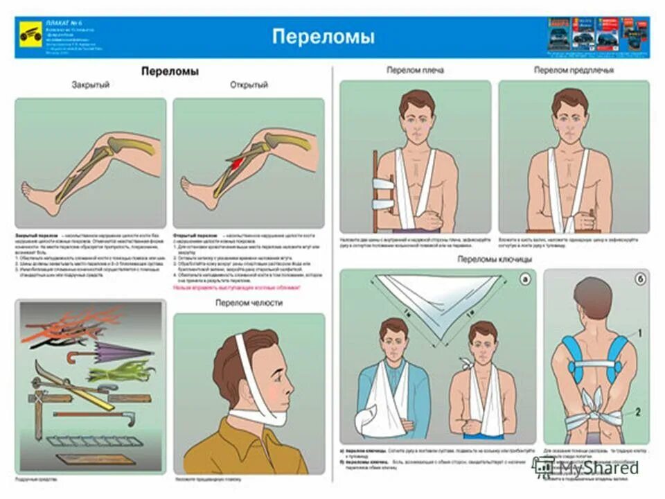 оказание первой помощи при переломах кратко. переломы костей конечностей действия по оказанию первой помощи. порядок оказания первой помощи при переломах. последовательность оказания первой медицинской помощи при переломах. при оказании первой медицинской помощи при переломе.