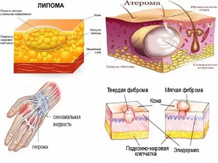 Доброкачественное новообразование жировой ткани кожи