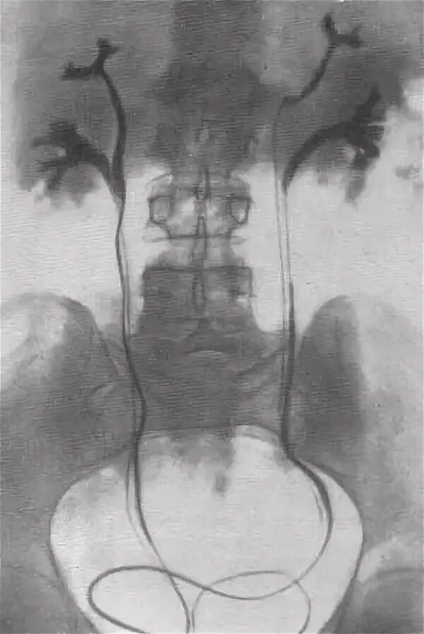 Удвоение мочеточника. Удвоение почки экскреторная урография. Удвоение мочеточника рентген. Удвоение ЧЛС рентген. Неполное удвоение почки рентген.
