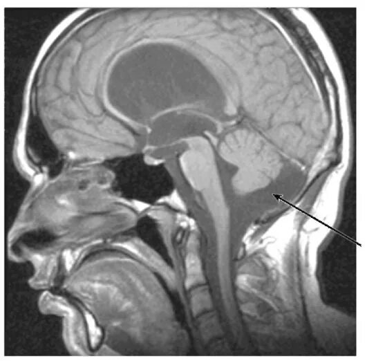 мозжечок арнольда киари. эктопия миндалин мозжечка мрт. симметричная эктопия миндалин мозжечка.