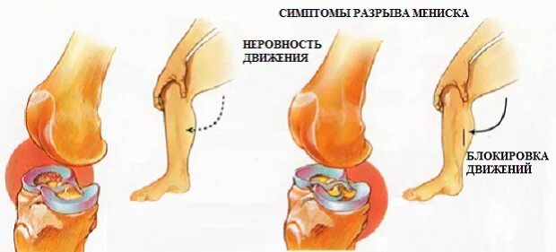 Травма мениска колена симптомы. Разрыв мениска коленного сустава симптомы. Симптомы повреждения менисков коленного сустава. Повреждение мениска колена симптомы.