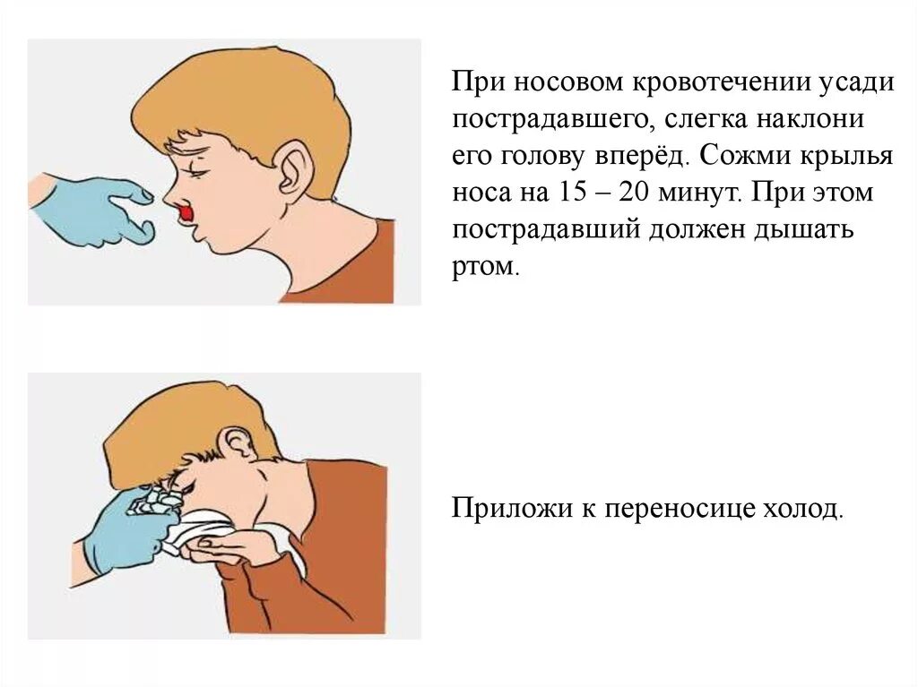 Холод при носовом кровотечении. При массовом кровотечении. При носовом кровотечении у пострадавшего необходимо. При носовом кровотечении. Оказание первой помощи при носовом кровотечении.