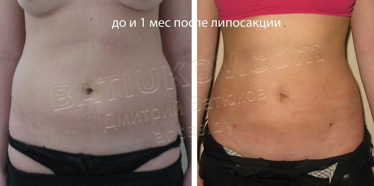 Уплотнения после липосакции. Последствия липосакции живота.