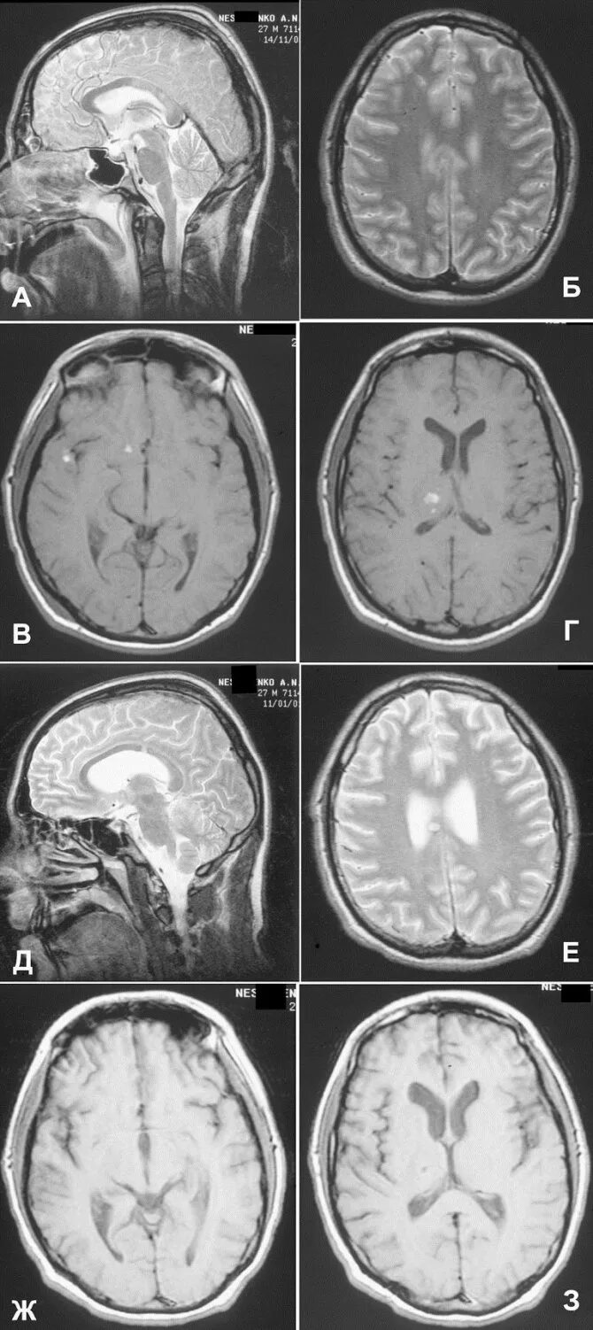 Диффузно аксональные повреждения головного мозга кт. Диффузное аксональное повреждение головного мозга мрт. Диффузное аксональное повреждение кт и мрт. Мрт головного мозга норма т2.