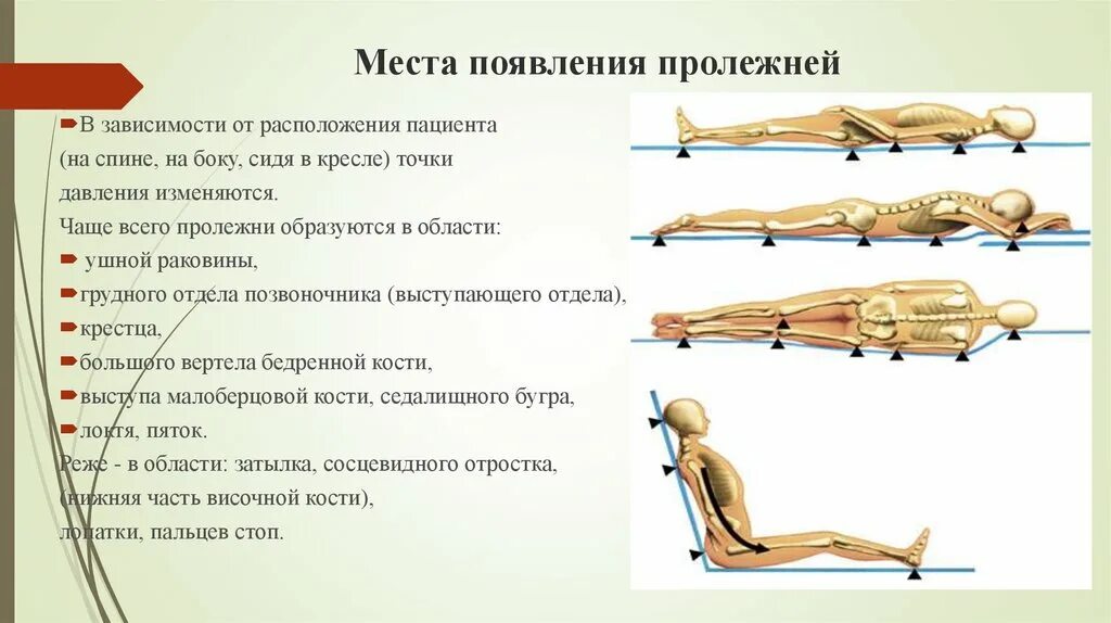 Пролежни в положении на боку. Частые места образования пролежней. места образования пролежней в положении сидя. места образования пролежней у пациента лежащего на животе. силы, вызывающие образование пролежней пациент:.