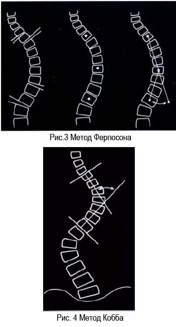 Метод Кобба сколиоз рентген. Угол Кобба степени сколиоза. Метод Фергюсона сколиоз. Угол сколиоза по методу Кобба. Угол кобба