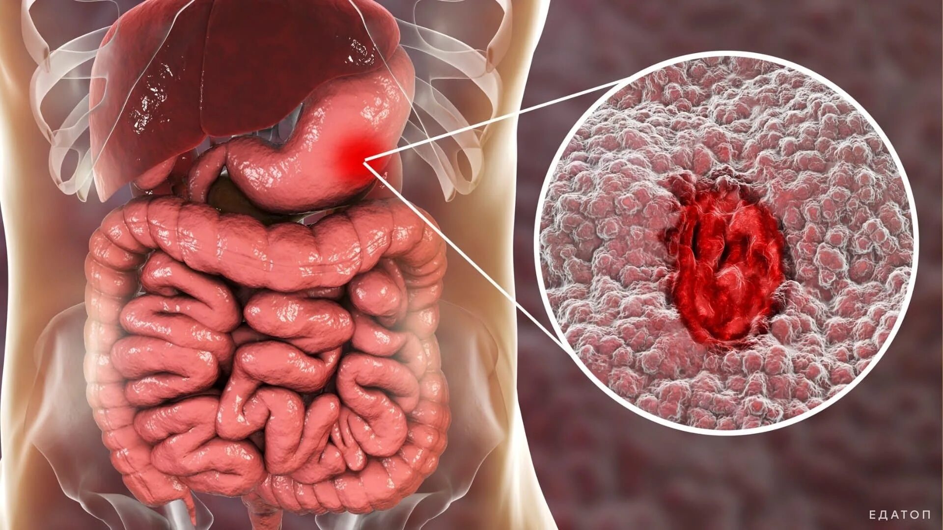 Хронический гастрит дуоденит. Заболевания пищеварительной системы человека. Каллезная язва желудка. Заболевание желудочно кишечного тракта гастрит. Хронический эрозивный гастрит.