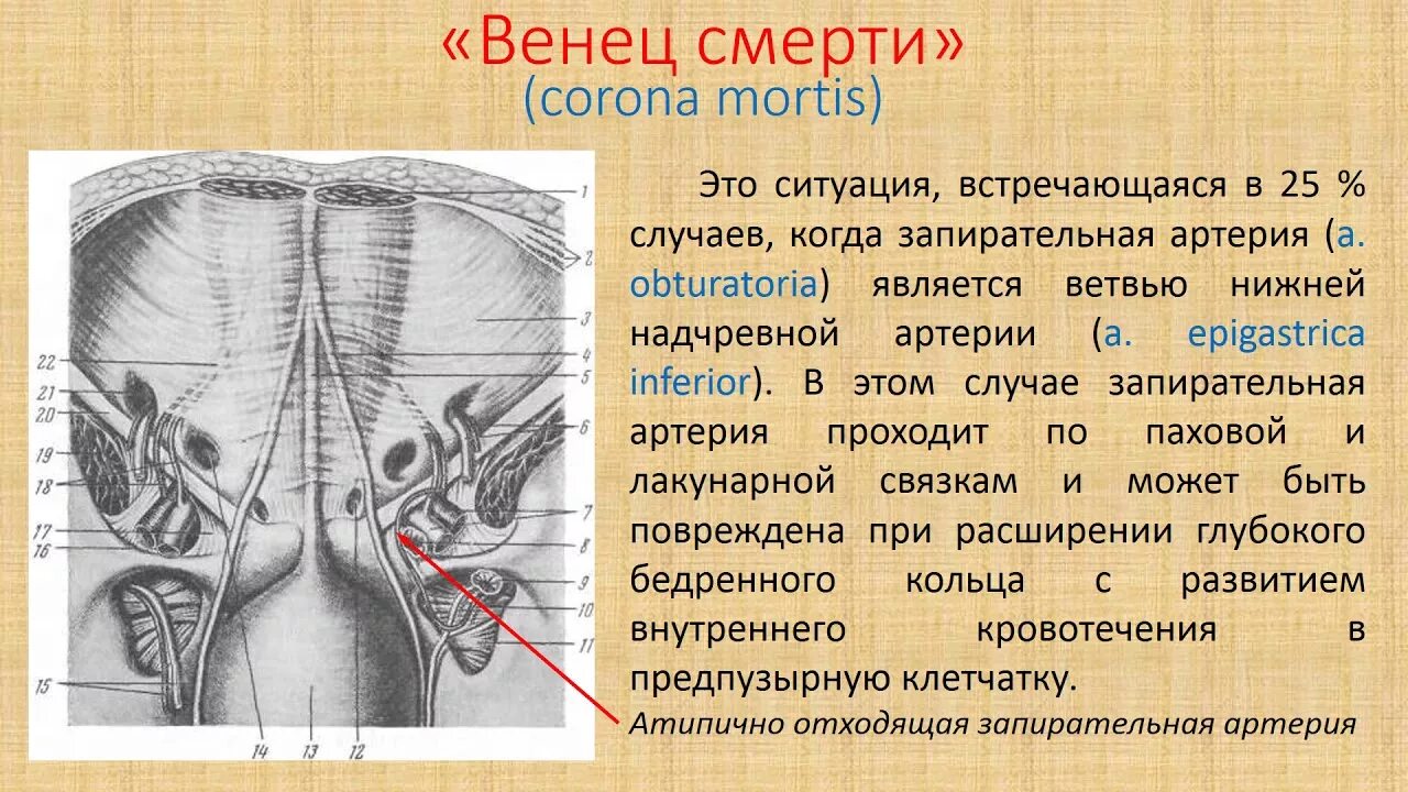 Ущемленная бедренная грыжа. Корона смерти бедренная грыжа. Топография пахового канала анатомия. Корона смерти при бедренной грыже. Корона смерти бедренного канала.