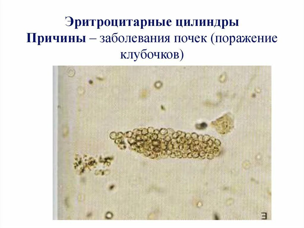 Повышены цилиндры в моче. Цилиндрурия гиалиновые цилиндры. Гиалиновые и зернистые цилиндры в моче. Зернистый цилиндр в моче микроскопия. Гиалиновый цилиндр в моче микроскопия.