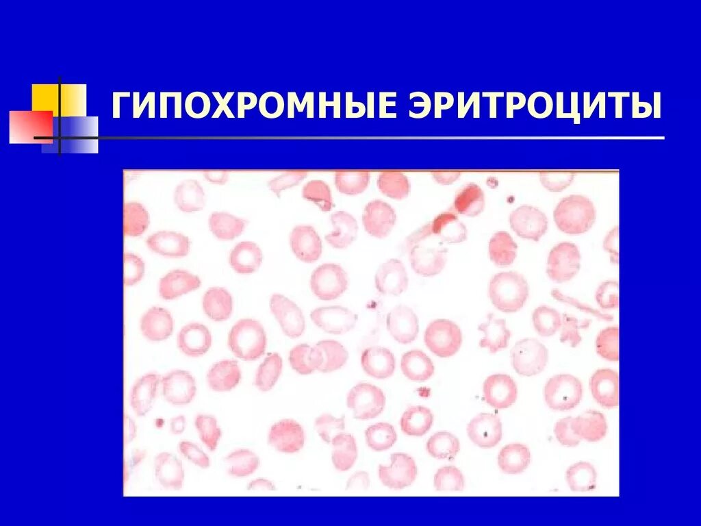 Гипохромия микроцитоз. Гипохромная анемия эритроциты. Гипохромия и микроцитоз эритроцитов. Анизоохромные эритроциты.