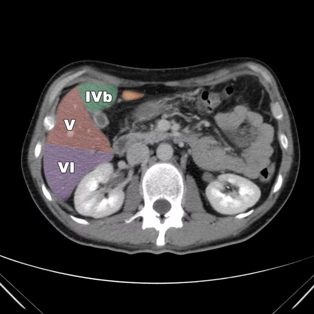 4 Сегмент печени на кт. Сегменты печени кт радиография. Сегменты печени мрт кт. Сегментарное строение печени на кт. Кт норма печень