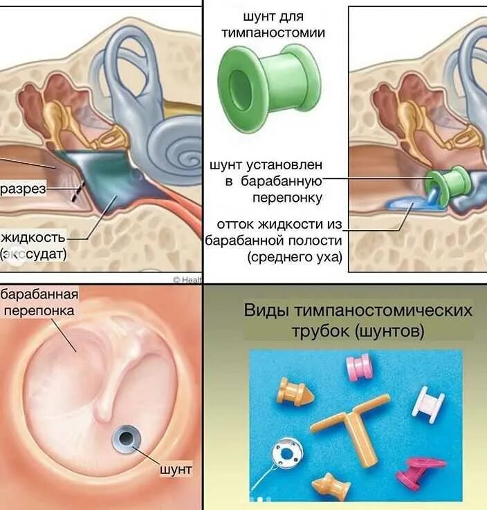 Атит что такое и как лечить