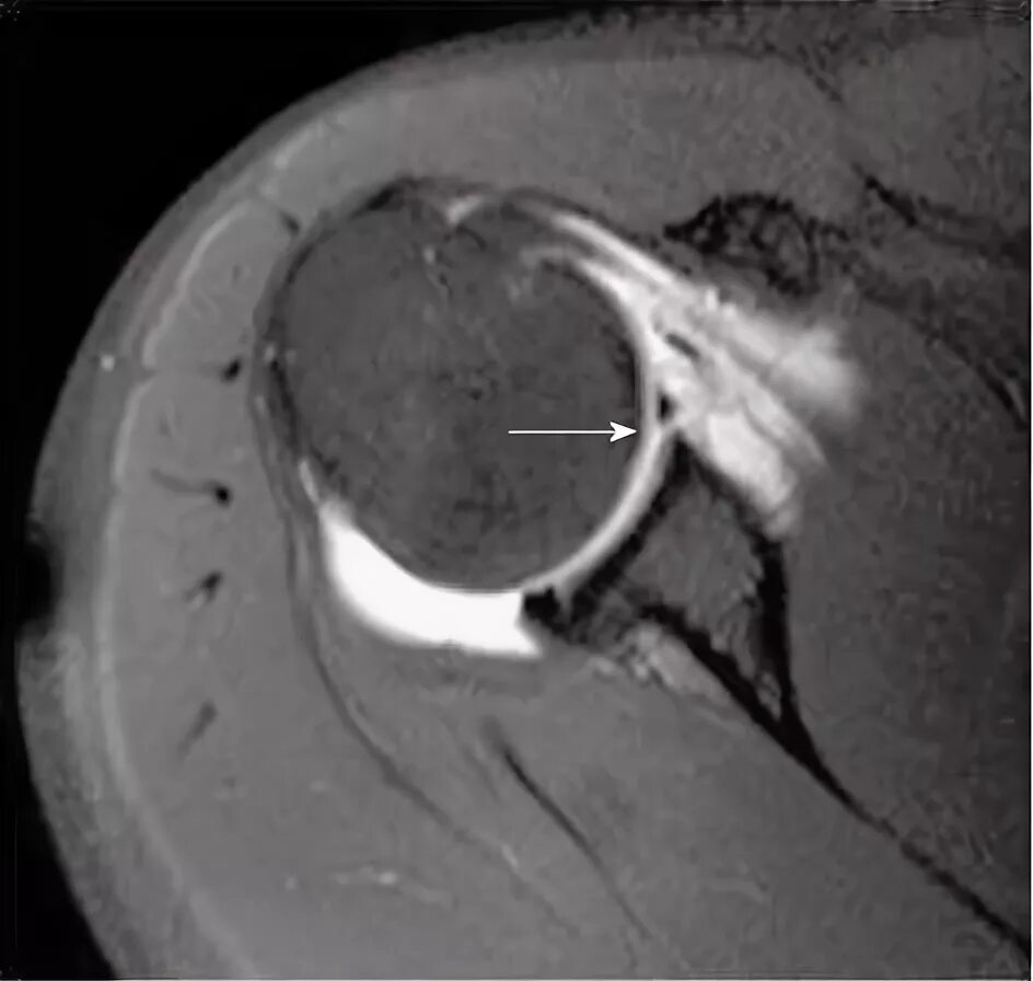 Банкарта плечевого сустава мрт. Повреждение Банкарта плечевого сустава мрт. Повреждение суставной губы гленоида лопатки мрт.
