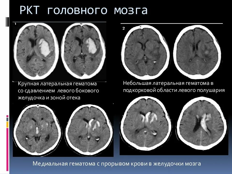 Размер инсульта. Геморрагическая трансформация ишемического инсульта типы. Ишемический инсульт на кт головного мозга. Вентрикулярный геморрагический инсульт. Геморрагический вентрикулярный инсульт клиника.