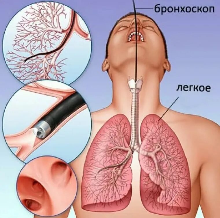 Бронхит - суть, виды и формы, причины и симптомы, диагностика
