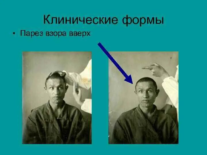 Взор вверх. Парез вертикального взора. парез горизонтального взора. паралич взора в сторону очага.