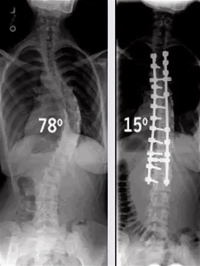 Сколиоз 2 степени рентген. Сколиоз 17 градусов рентген. Сколиоз 4 степени рентген. Сколиоз угол искривления 17 градусов.