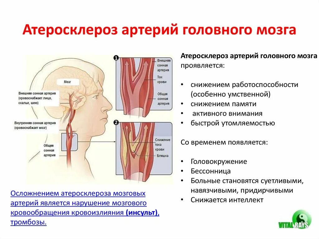 Сужение правой артерии. Атеросклероз экстракраниального отдела сонных артерий. Атеросклероз магистральных артерий головы симптомы. Симптомы при атеросклерозе артерий головного мозга. Атеросклероз брахиоцефальных артерий клиника.