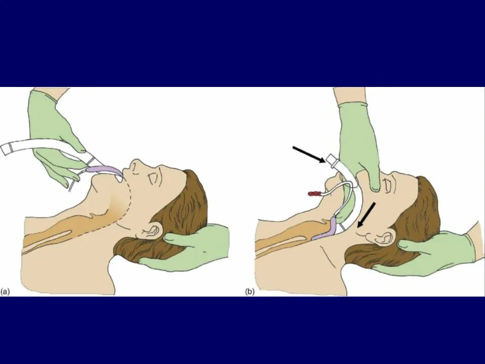 Трубка при наркозе. Интубация ларингеальной маской. Методика постановки ларингеальной маски. Ларингеальная маска для ИВЛ. Ларингеальная маска алгоритм.