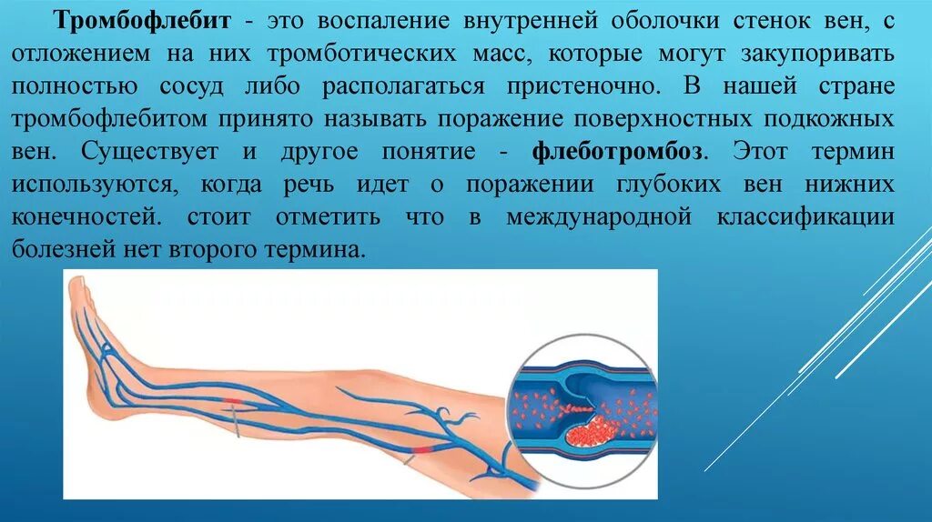 Тромбофлебит воспаление. Тромбофлебит поверхностных вен. Тромбоз определение