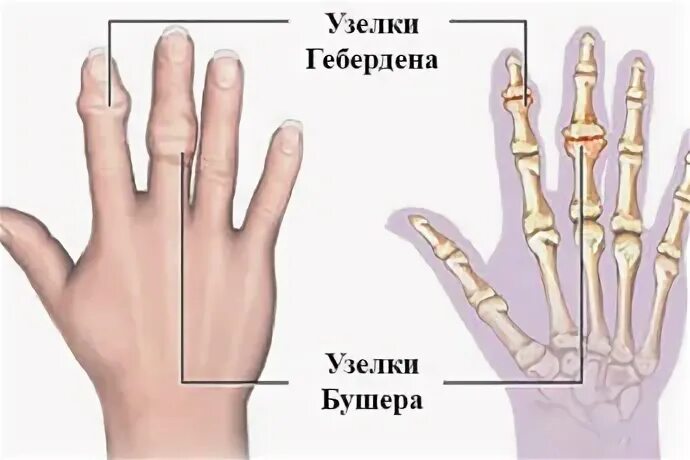 Узелки бушара ревматоидный артрит. Узелки гебердена и бушара рентген. Остеоартроз узлы гебердена. Узелки гебердена и бушара характерны для. Узелки гебердена и бушара рентген.