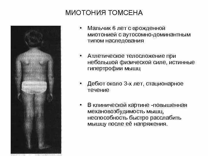 Миотония Томсена Тип наследования. Дистрофическая миотония Россолимо-Штейнерта-Куршмана. Врожденная дистрофическая миотония. Миотония - этиология, патогенез. Миотония это