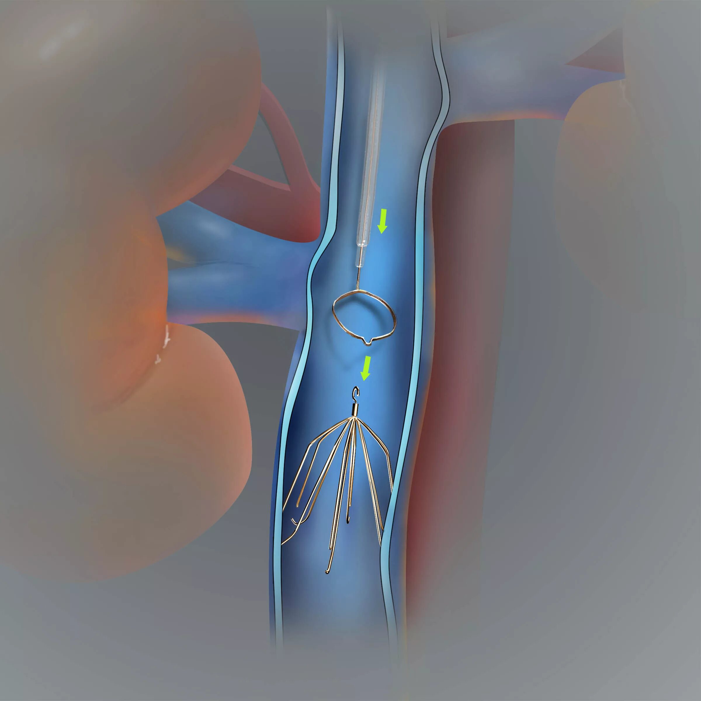 Нижняя полая Вена с кава фильтром. Кава фильтр имплантируется в. Илеофеморальный венозный тромбоз. Кава фильтр в нижнюю полую Вену. Тромбоз почечных вен