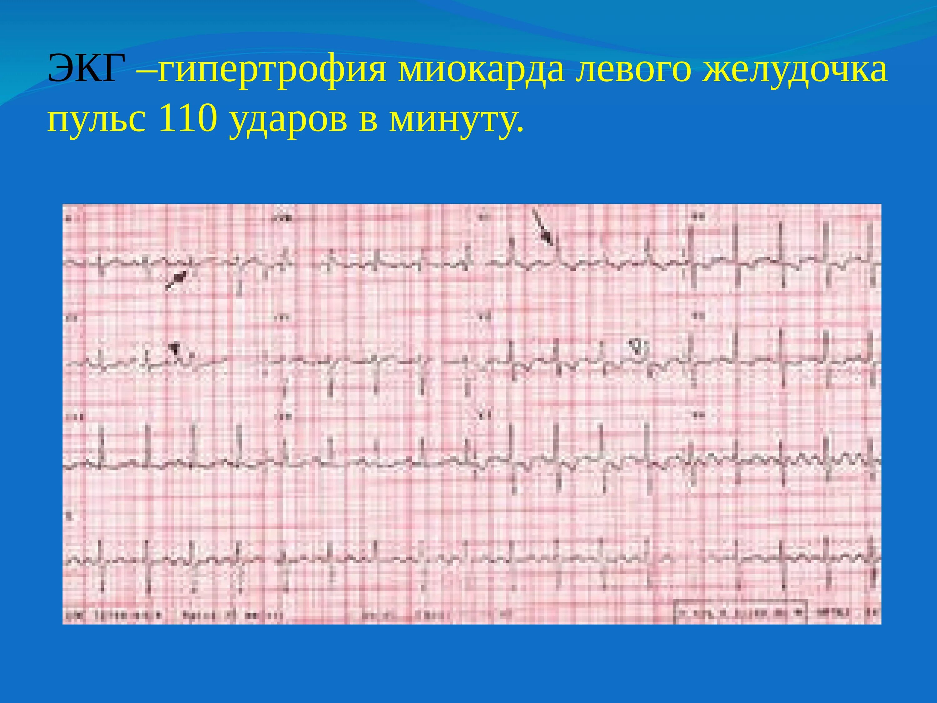 Гипертрофия левого миокарда ЭКГ. Гипертрофия левого желудочка сердца на ЭКГ. Кардиограмма гипертрофия левого желудочка. Гипертрофия миокарда на ЭКГ. Экг преобладание левого желудочка