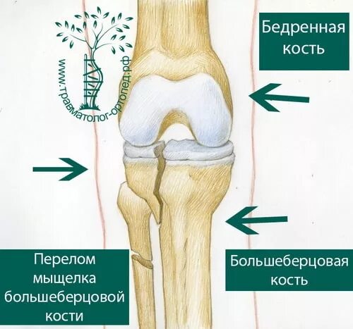 Мыщелка берцовой. Перелом сустава берцовой кости. Наружный мыщелок большой берцовой кости. Перелом мыщелка берцовой кости коленного сустава. Перелом мыщелка большеберцовой кости.